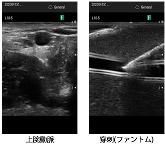 上腕動脈　穿刺(ファントム)